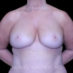 Bellesoma Breast Lift Before & After Patient #8463
