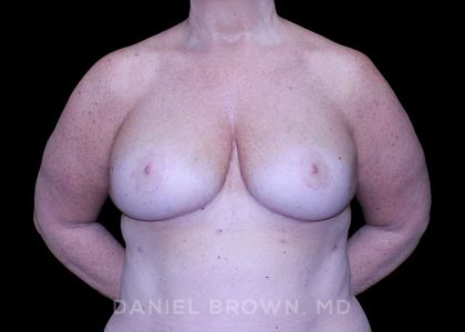 Bellesoma Breast Lift Before & After Patient #8463