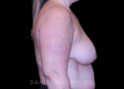Bellesoma Breast Lift Before & After Patient #8463