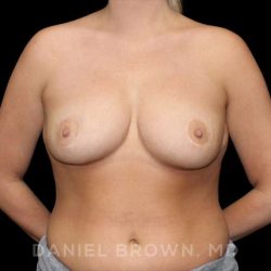 Bellesoma Breast Lift Before & After Patient #8474