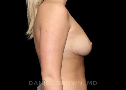 Bellesoma Breast Lift Before & After Patient #8474