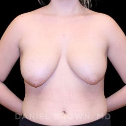 Bellesoma Breast Lift Before & After Patient #8474