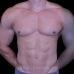 Gynecomastia Before & After Patient #10233