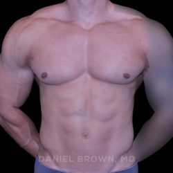 Gynecomastia Before & After Patient #10233