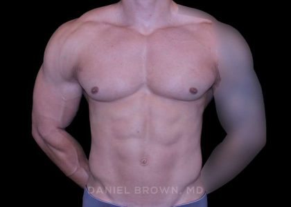 Gynecomastia Before & After Patient #10233