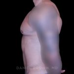 Gynecomastia Before & After Patient #10233