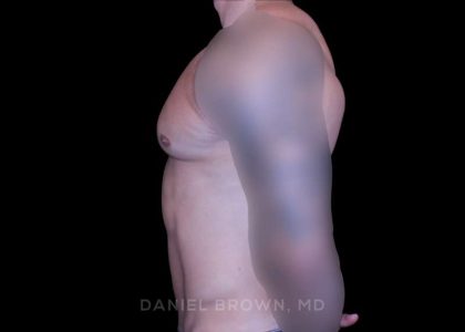 Gynecomastia Before & After Patient #10233