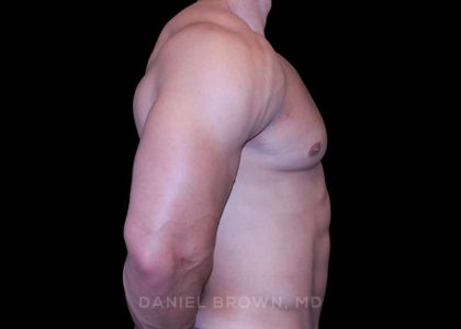 Gynecomastia Before & After Patient #10233