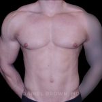 Gynecomastia Before & After Patient #10233