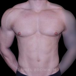 Gynecomastia Before & After Patient #10233