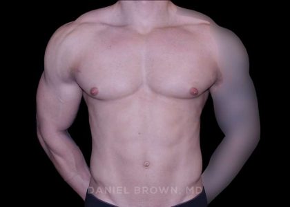 Gynecomastia Before & After Patient #10233