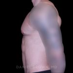 Gynecomastia Before & After Patient #10233