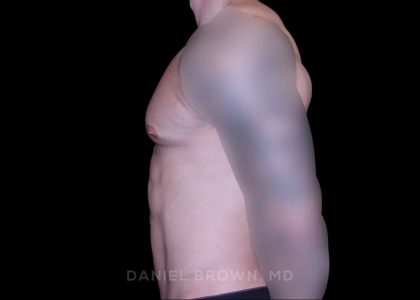 Gynecomastia Before & After Patient #10233