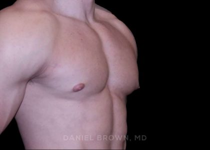 Gynecomastia Before & After Patient #10233