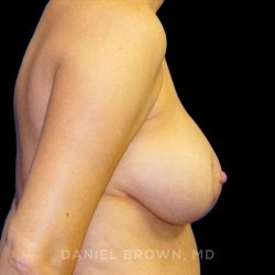 Breast Lift Before & After Patient #9522
