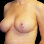 Breast Lift Before & After Patient #9522