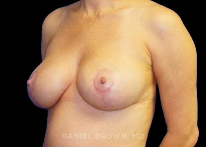 Breast Lift Before & After Patient #9522