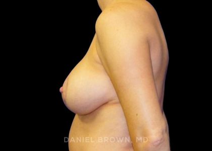 Breast Lift Before & After Patient #9522