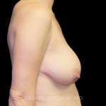 Breast Lift Before & After Patient #9522
