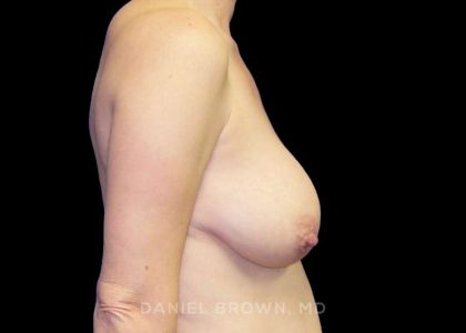 Breast Lift Before & After Patient #9522