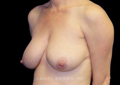 Breast Lift Before & After Patient #9522