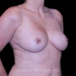 Breast Lift Before & After Patient #9544