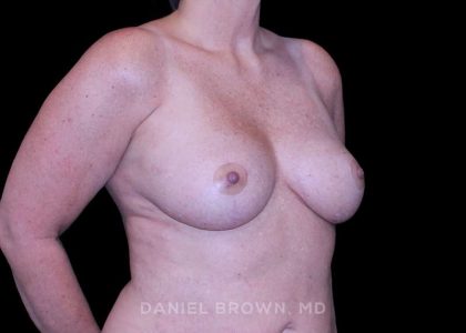 Breast Lift Before & After Patient #9544