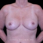 Breast Lift Before & After Patient #9544