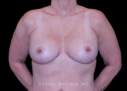 Breast Lift Before & After Patient #9544