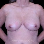 Breast Lift Before & After Patient #9544