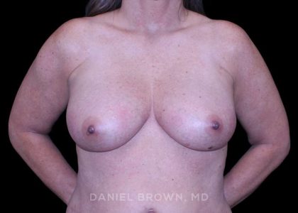 Breast Lift Before & After Patient #9544