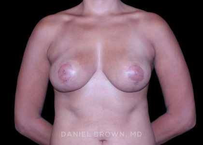 Breast Lift Before & After Patient #9555