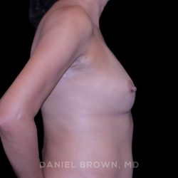 Breast Lift Before & After Patient #9566