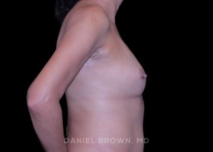 Breast Lift Before & After Patient #9566