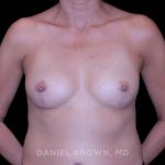 Breast Lift Before & After Patient #9566