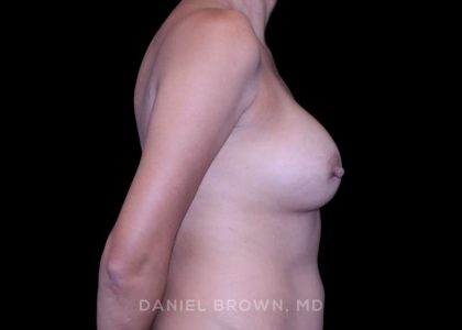 Breast Lift Before & After Patient #9566