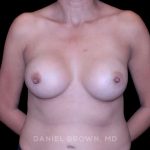 Breast Lift Before & After Patient #9566