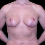Breast Lift Before & After Patient #9588