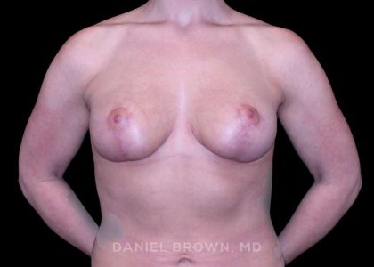 Breast Lift Before & After Patient #9588