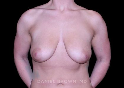 Breast Lift Before & After Patient #9588