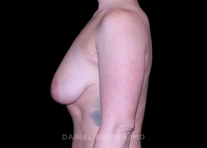 Breast Lift Before & After Patient #9588