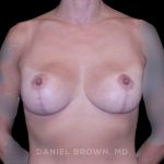 Breast Lift Before & After Patient #9599