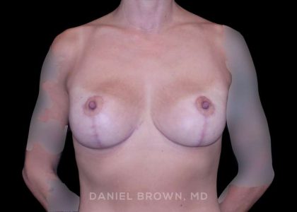 Breast Lift Before & After Patient #9599