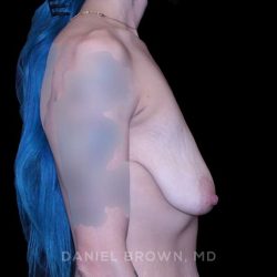 Breast Lift Before & After Patient #9599