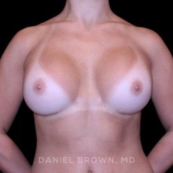 Breast Augmentation Before & After Patient #9317