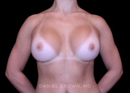 Breast Augmentation Before & After Patient #9317