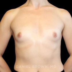 Breast Augmentation Before & After Patient #9317