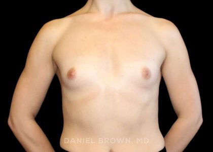Breast Augmentation Before & After Patient #9317
