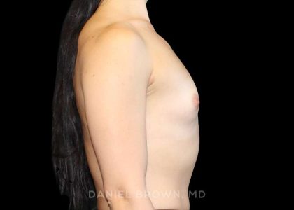 Breast Augmentation Before & After Patient #9317