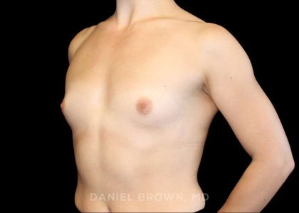 Breast Augmentation Before & After Patient #9317